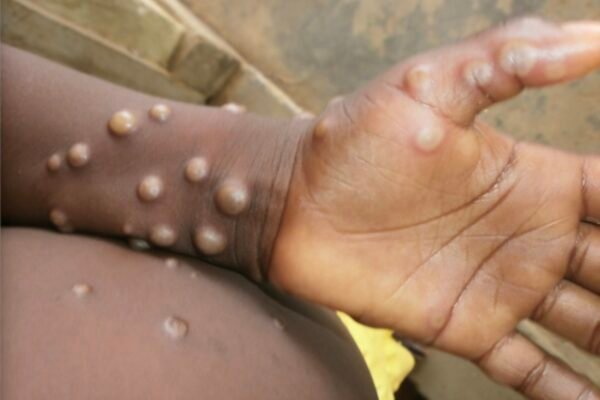 Mpox situation in India